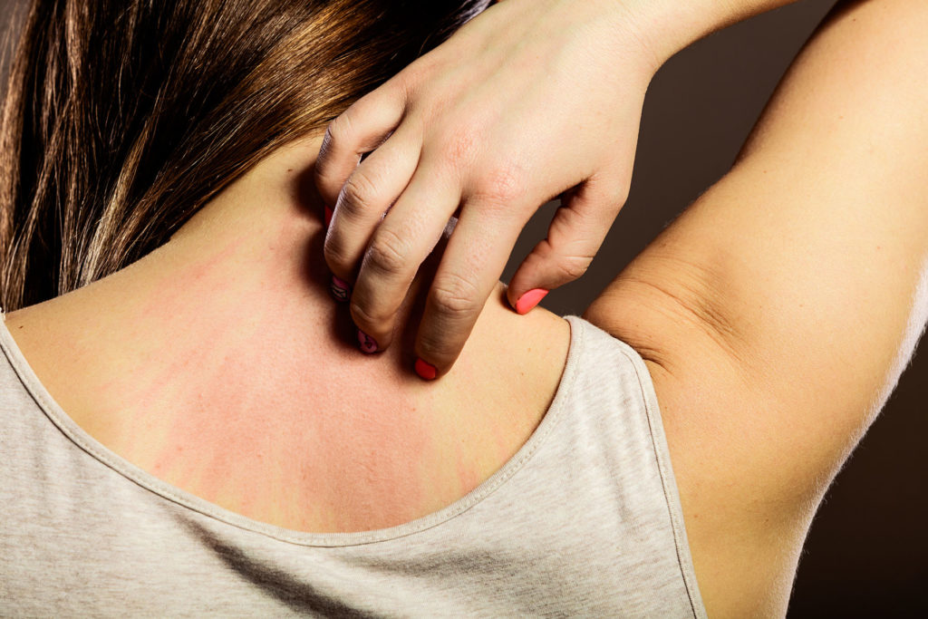 Woman's back red from scratching