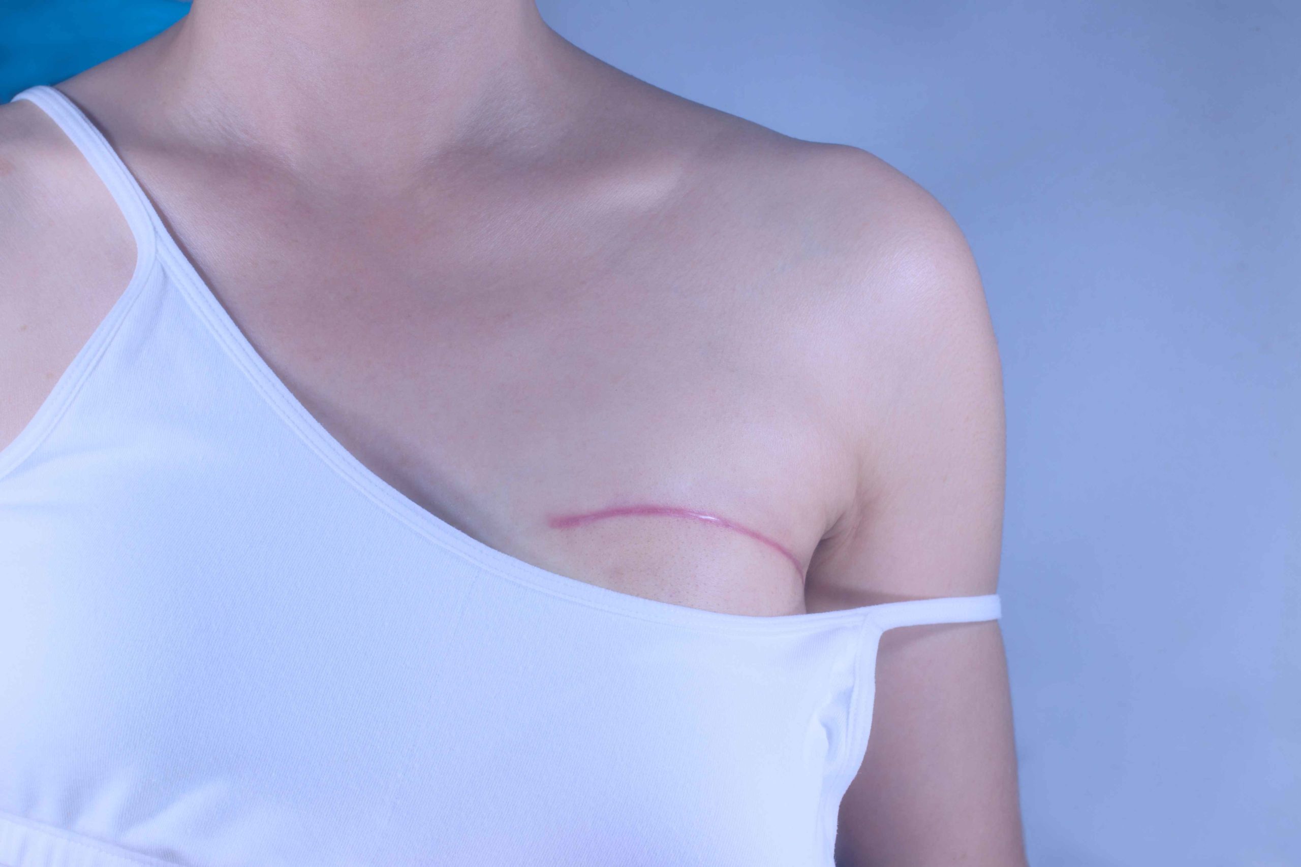 Going Flat Why Some Women Reject Breast Reconstruction Surgery