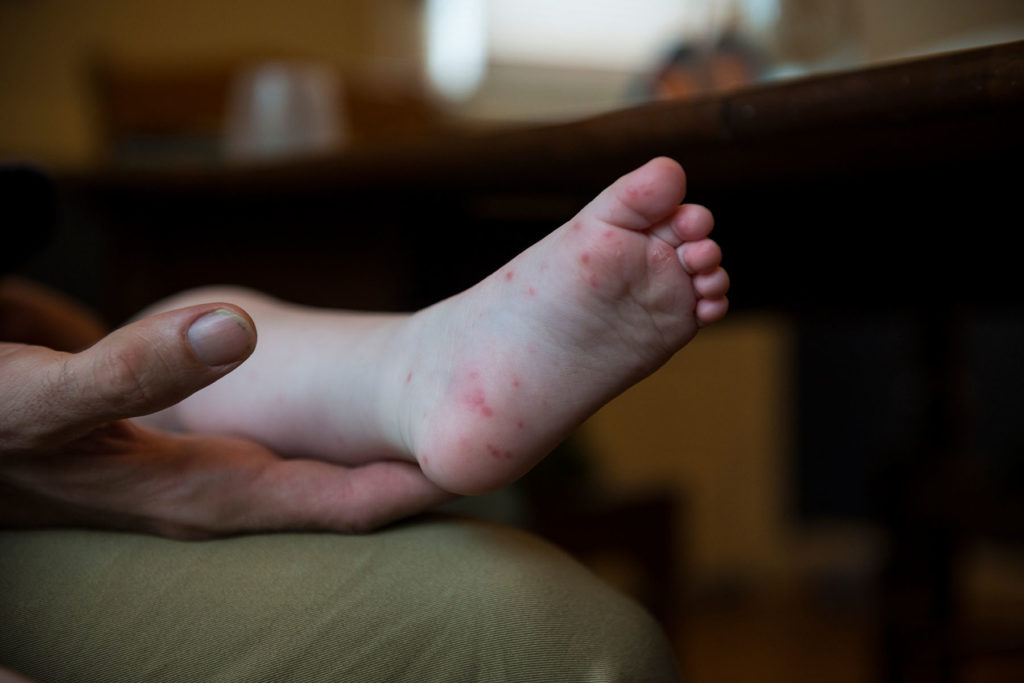 baby foot that has hand foot and mouth disease