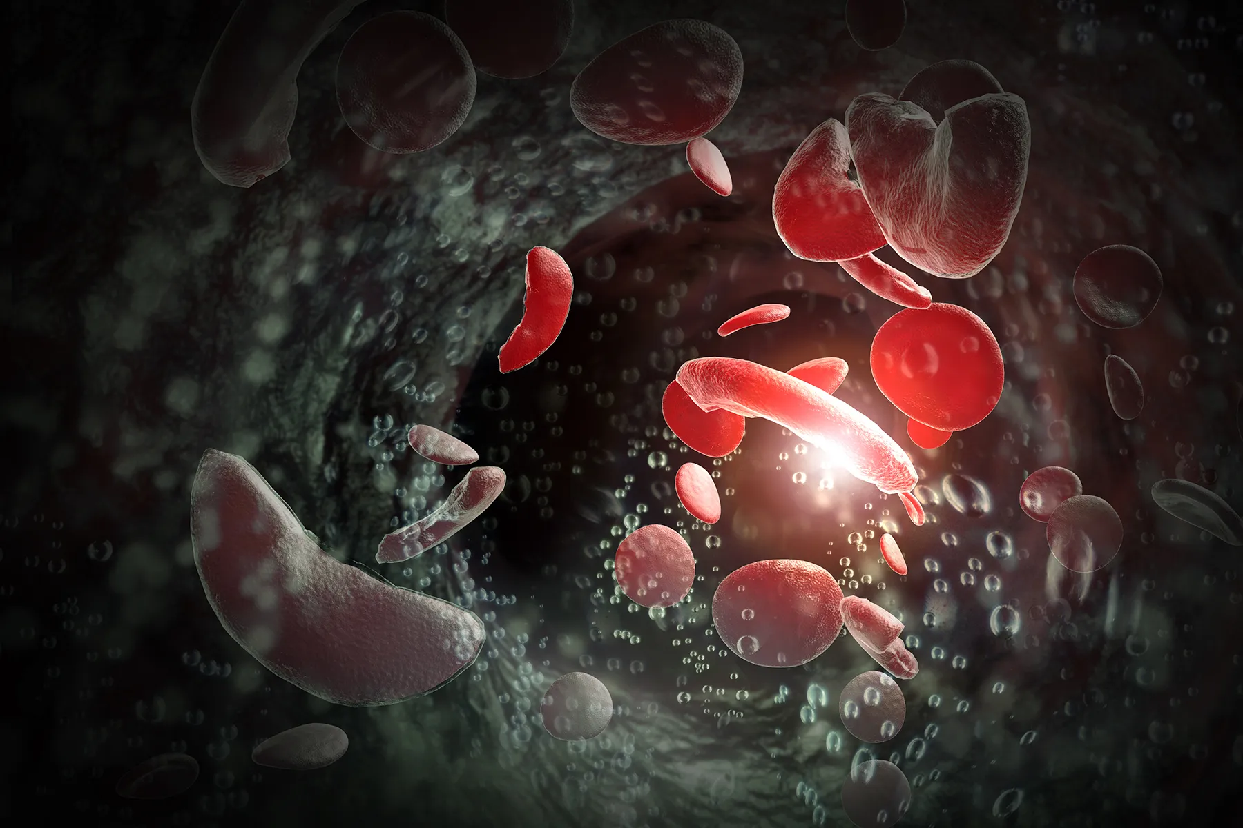 Microscopic 3D rendering depicting healthy red blood cells and elongated sickle cells circulating within a blood vessel.