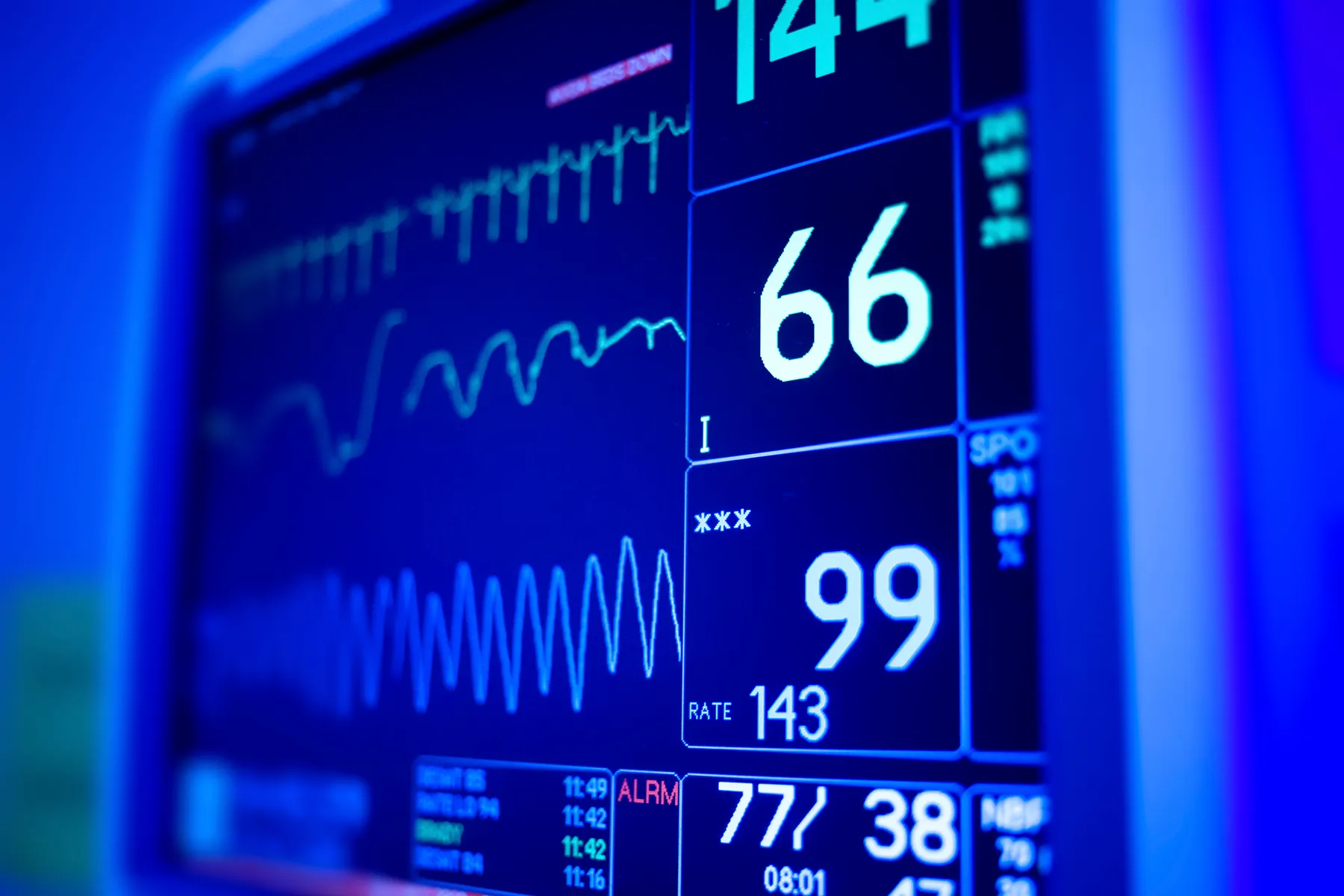 Close-up of a glowing blue medical monitor displaying real-time patient vital signs, including heart rate (143), SpO2 (99), and blood pressure (77/38), alongside dynamic waveforms.
