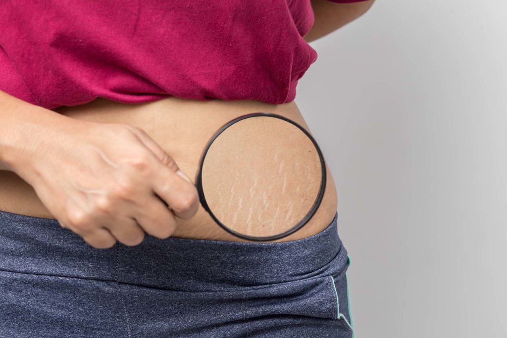 holding magnifier over stretch marks