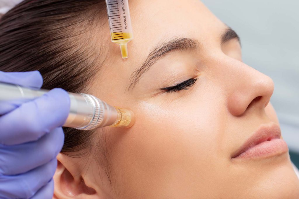 Close up shot of woman receiving microneedling treatment