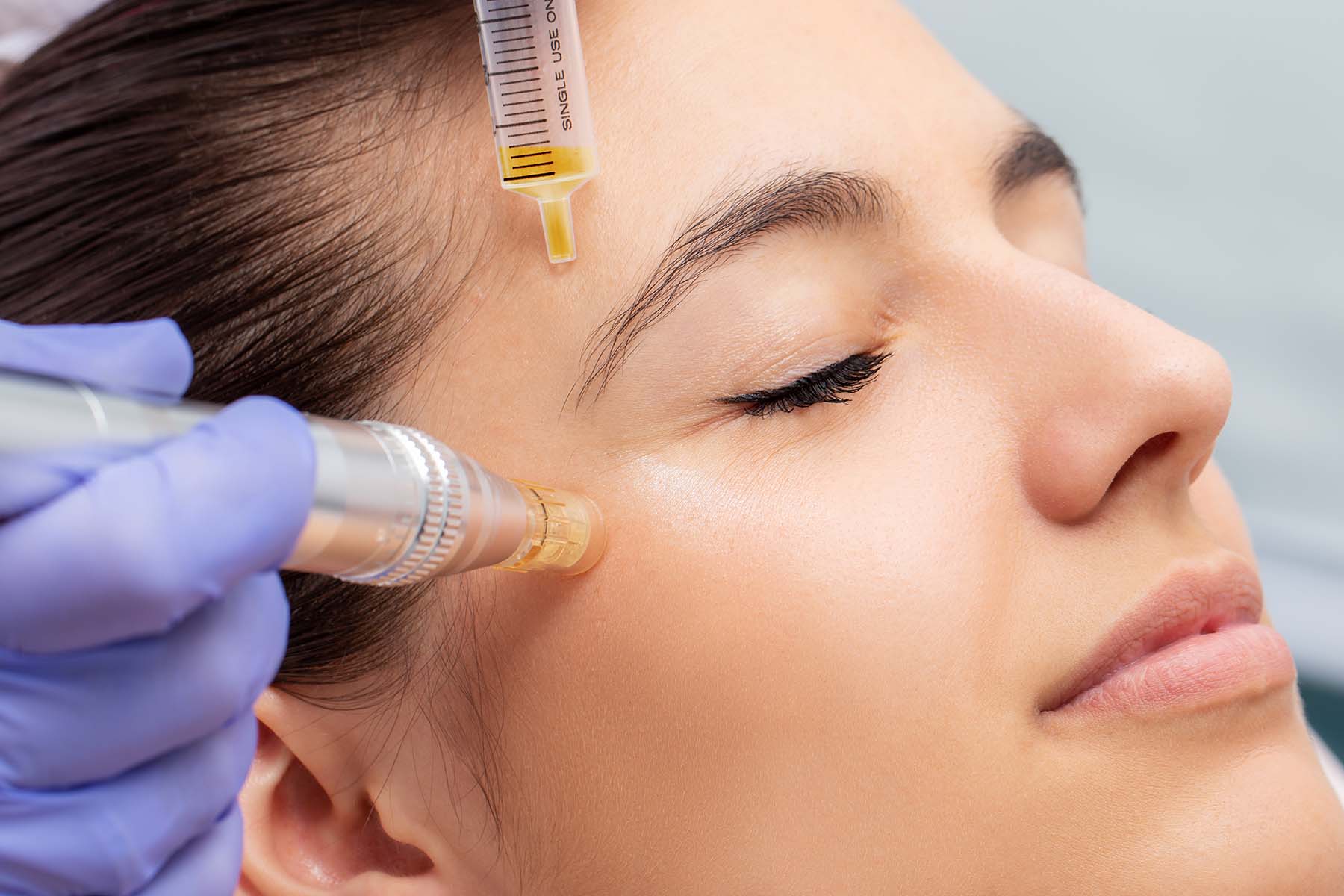 Close up shot of woman receiving microneedling treatment