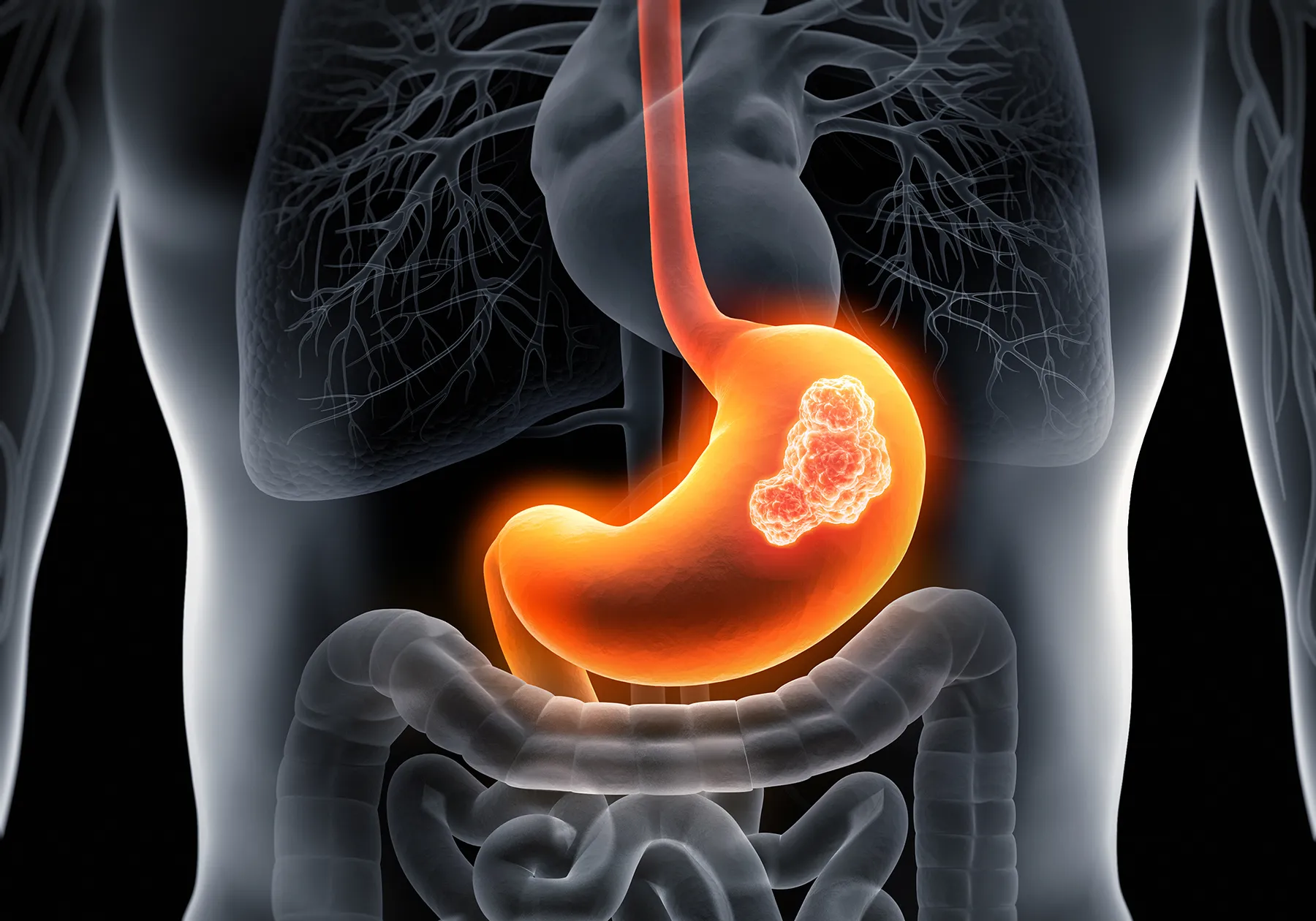 Medical illustration of human anatomy highlighting a prominent, glowing tumor in the stomach, depicting gastric cancer or stomach disease. The esophagus and intestines are also shown in a transparent view of the torso.