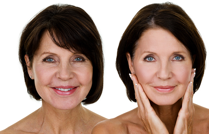 Side by side before and after of woman with facial rejuvenation