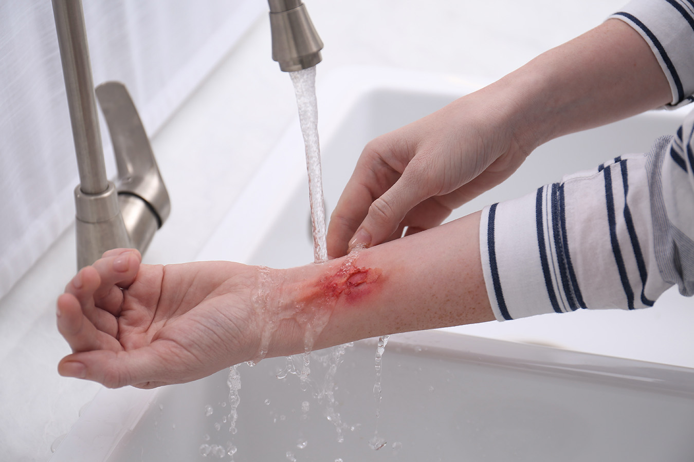 How to Avoid Ice Burn When Treating an Injury