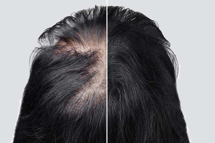 Stress-Induced Hair Loss: It Can Happen - UHealth Collective