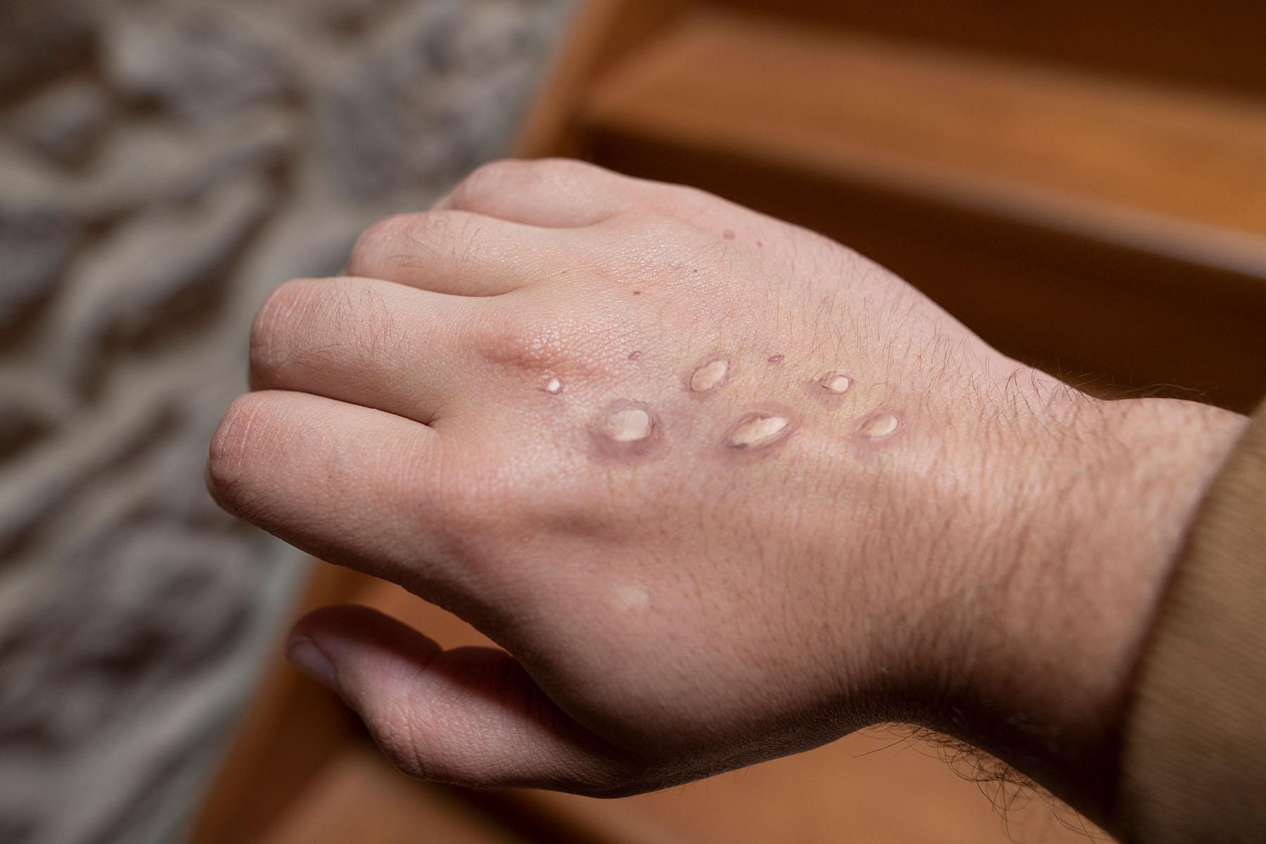 monkeypox lesions on back of hand