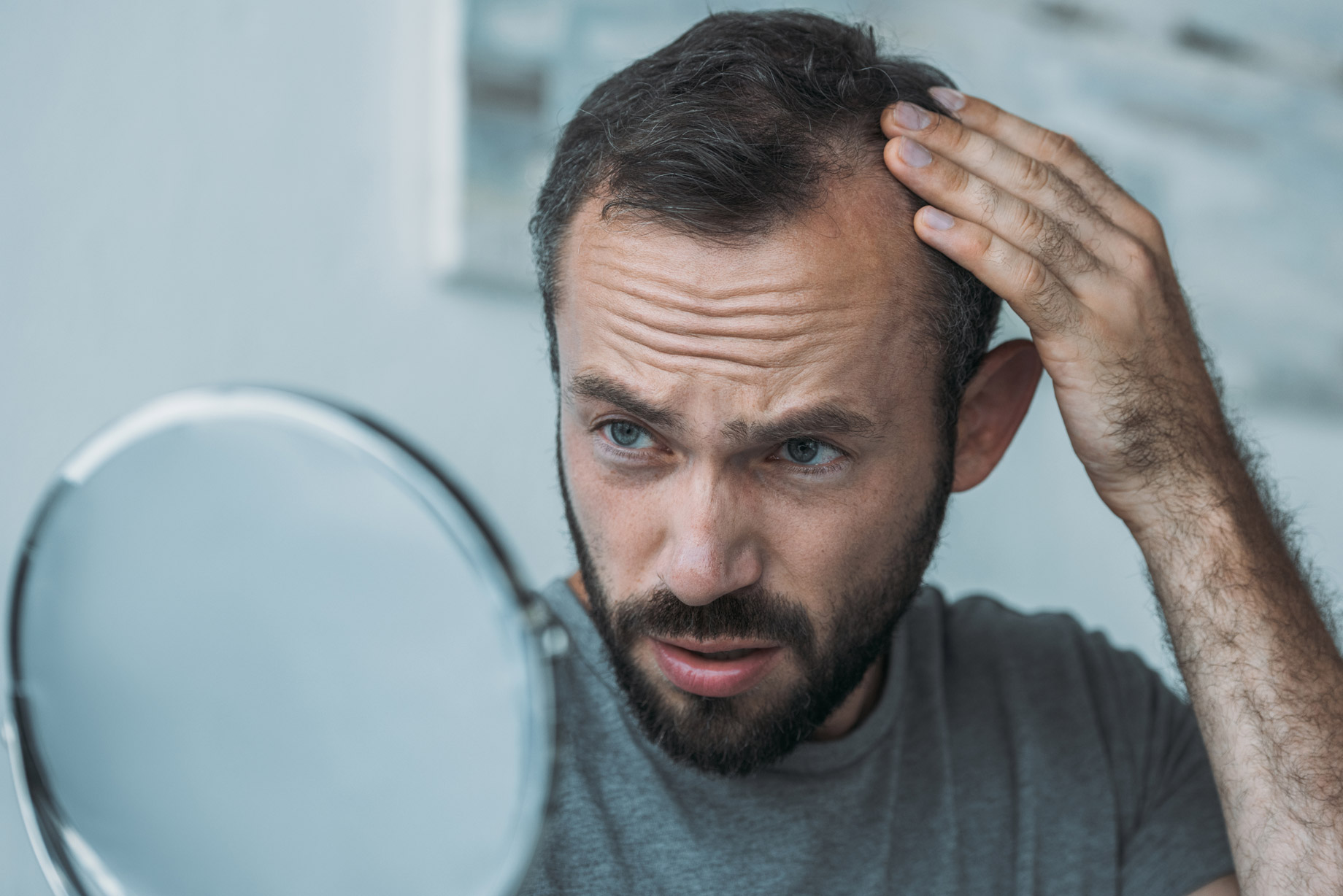 Alopecia Areata: What Causes this Hair Loss? - UHealth Collective