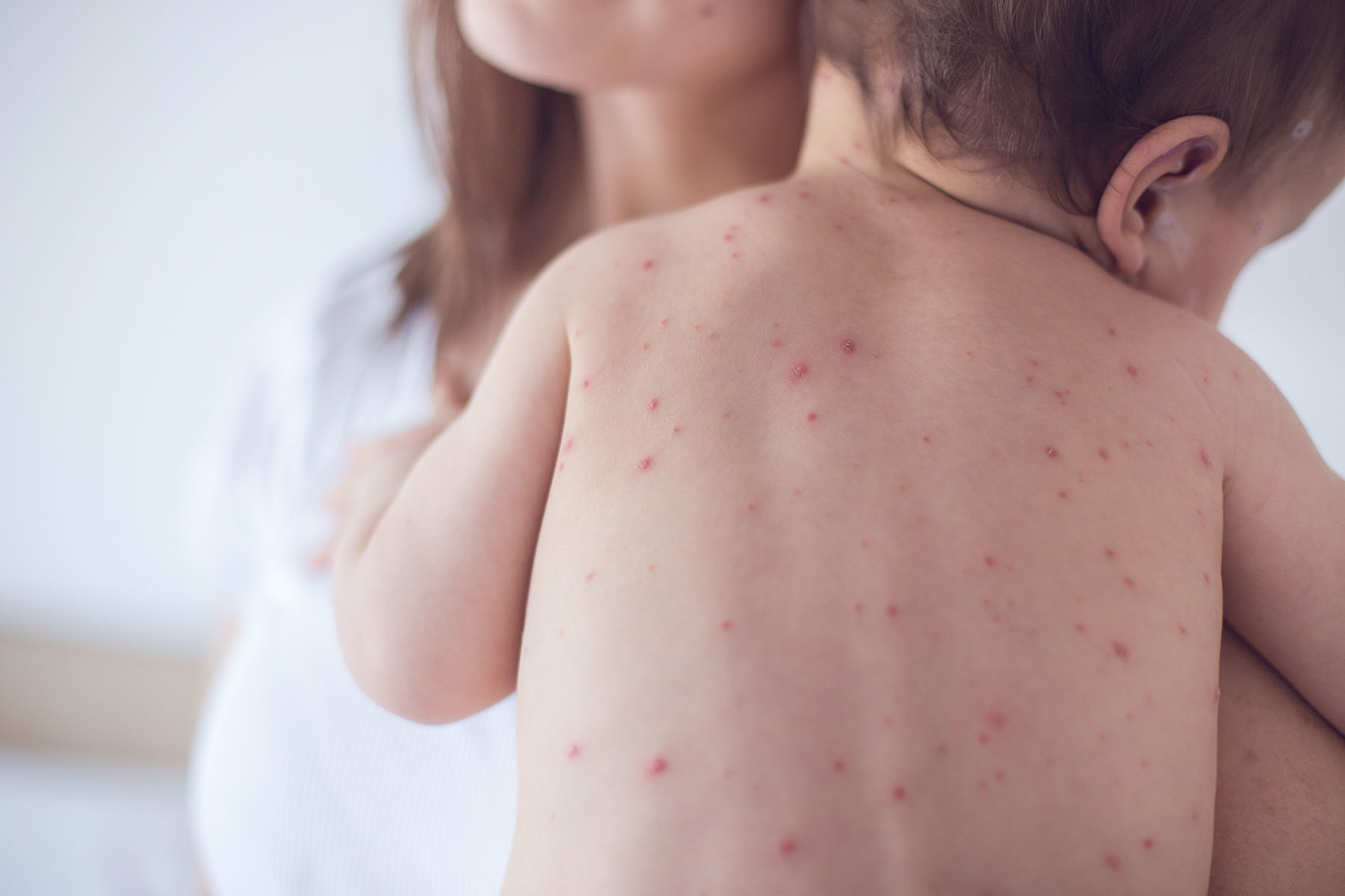 Mom holding baby who has chickenpox