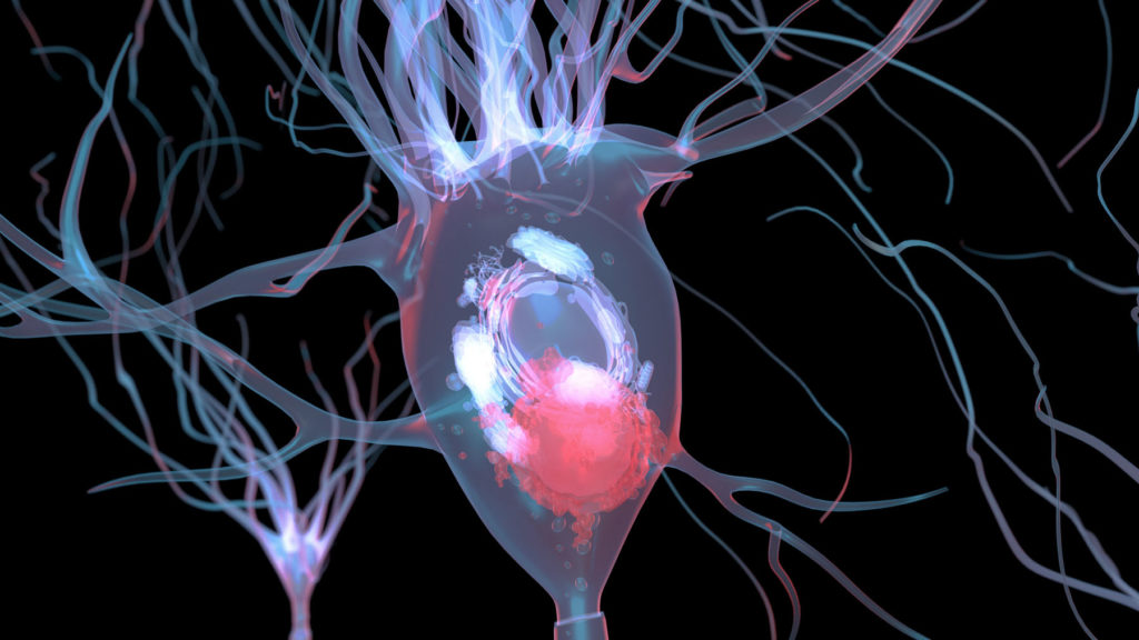 Lewy body in a neuron affected by Parkinson's disease: graphic model