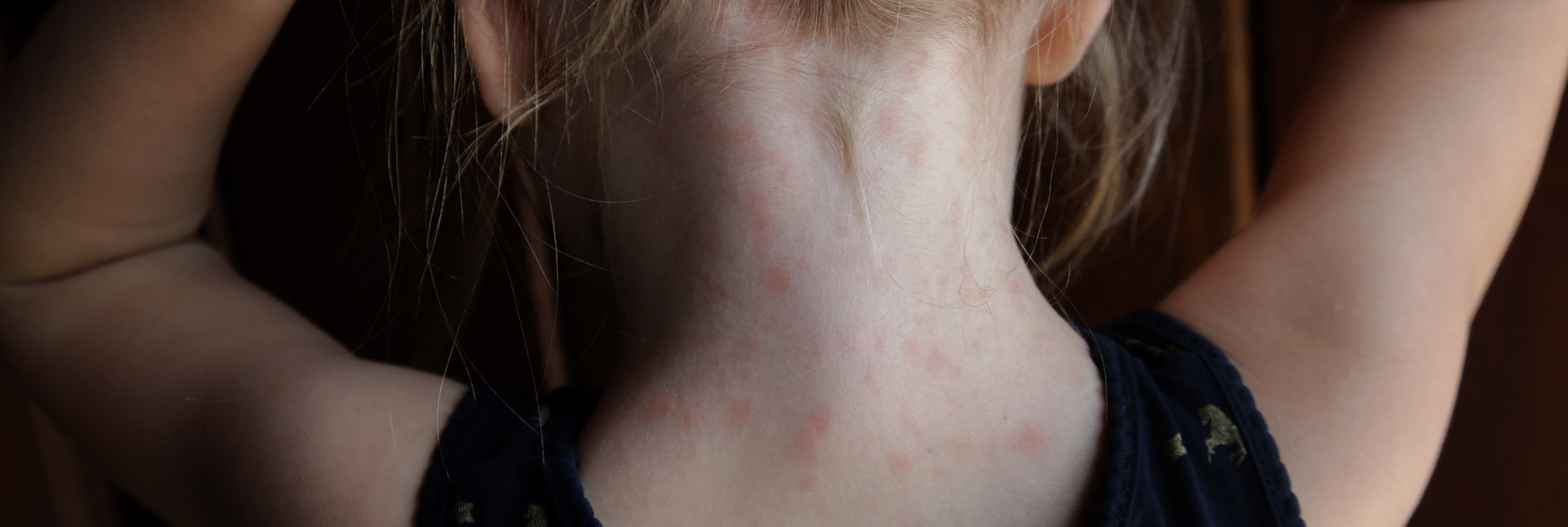 Girl showing the heat rash on her neck.