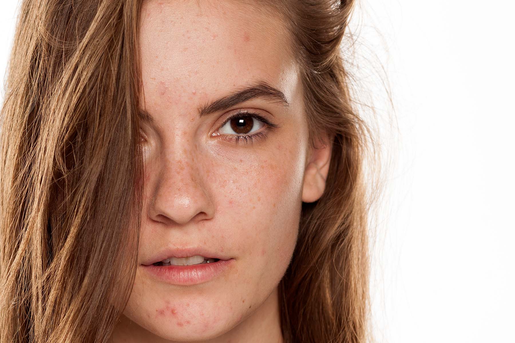 Headshot of pretty young woman with freckles and pimples on her face