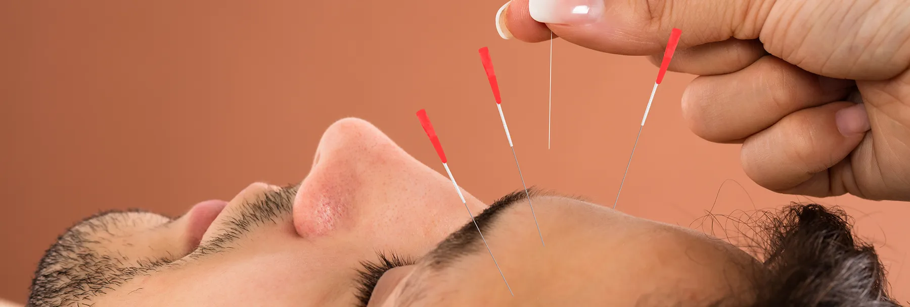Close up of man receiving acupuncture on his face