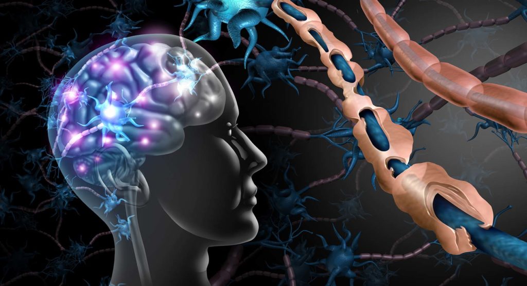 Graphic of brain with lighted neuron activity to illustrate multiple sclerosis (MS).