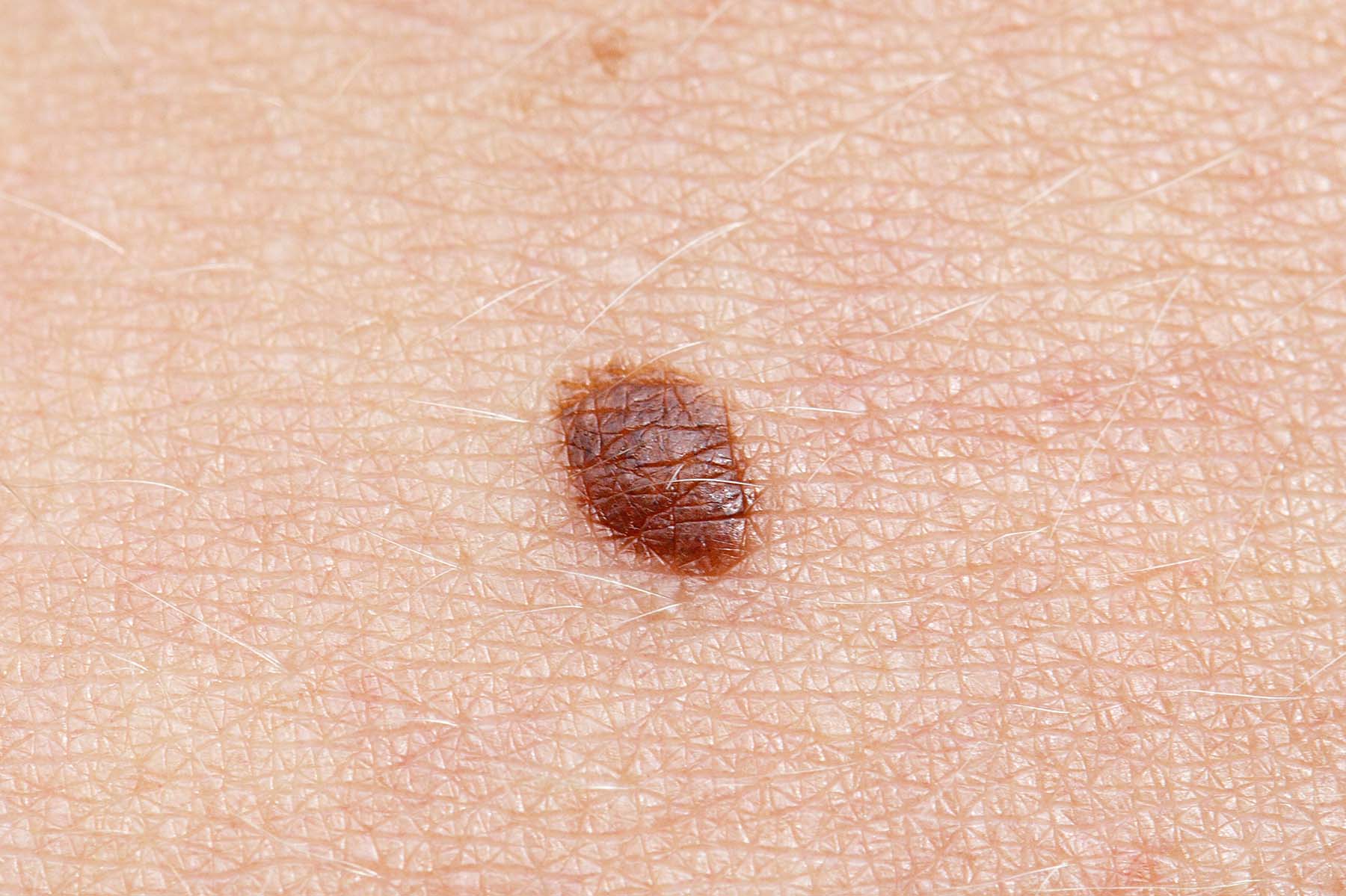 Close up of basal cell carcinoma on skin