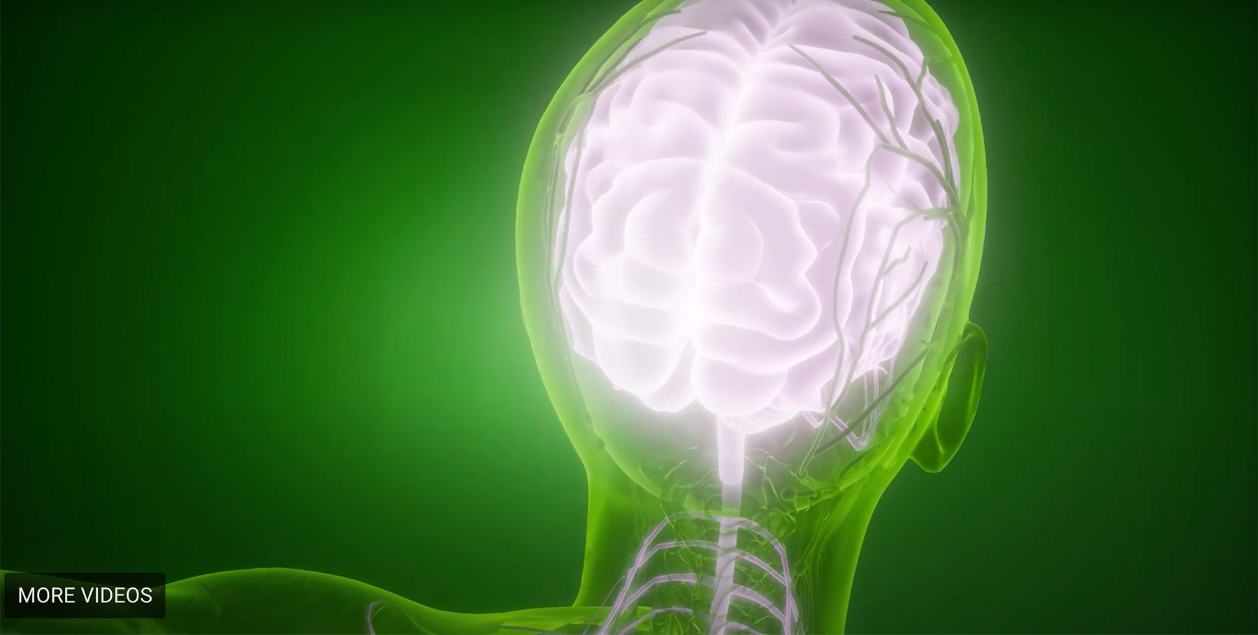 Brain graphic illustrating migraines on a green background.