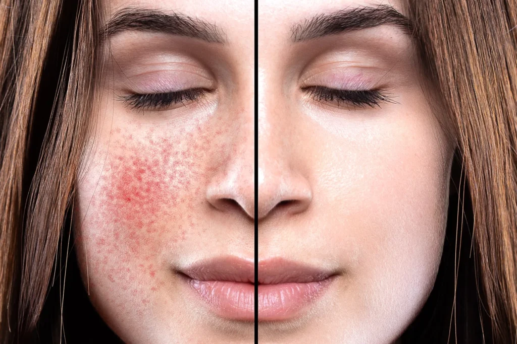 Before and after comparison of a woman's face, showing skin with redness and small blemishes on the left, and clear, smooth skin on the right.