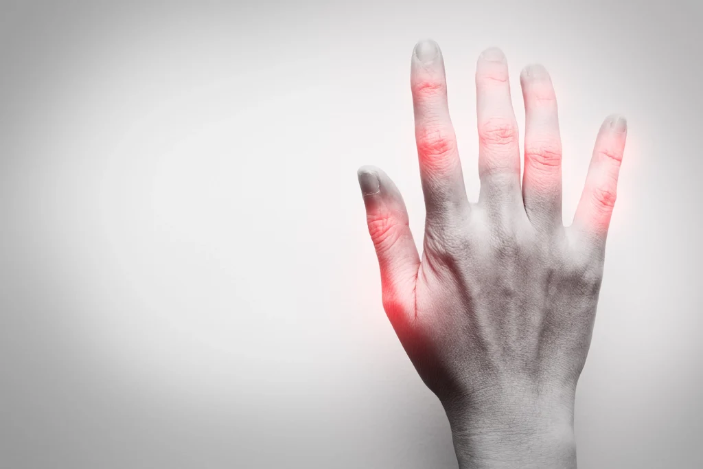 Black and white photo of hand with red areas to illustrate the pain of rheumatoid arthritis.