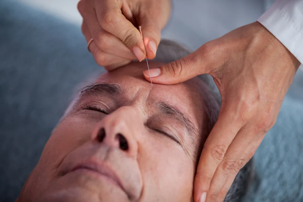 Senior man gets acupuncture treatment to forehead.