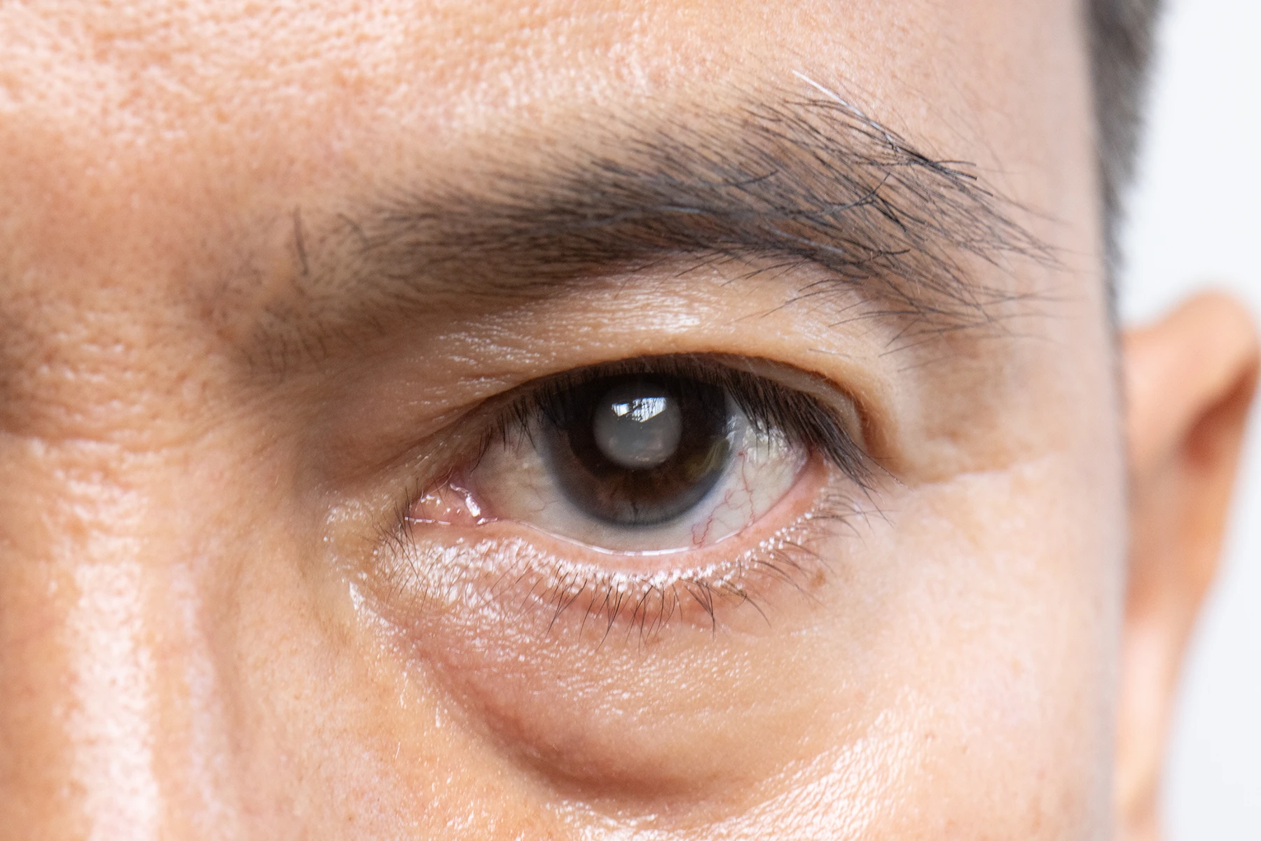 Close up image of a cataract patient's eye