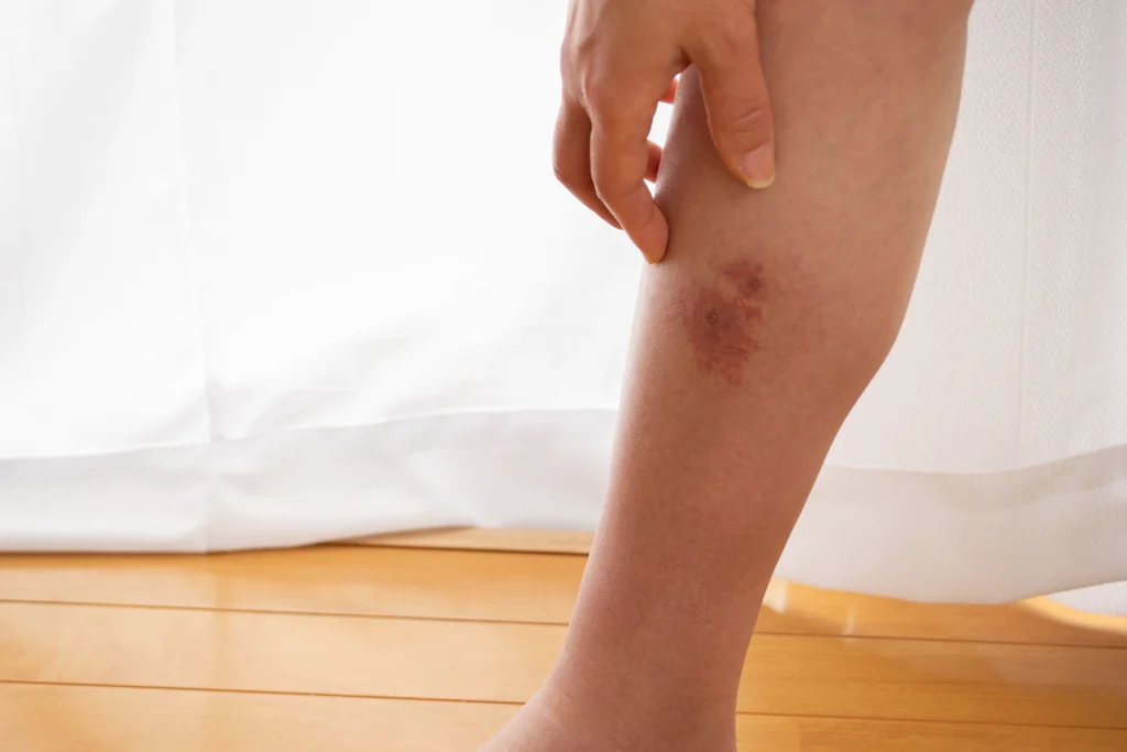 Close up of a cellulitis infection on a person's leg.