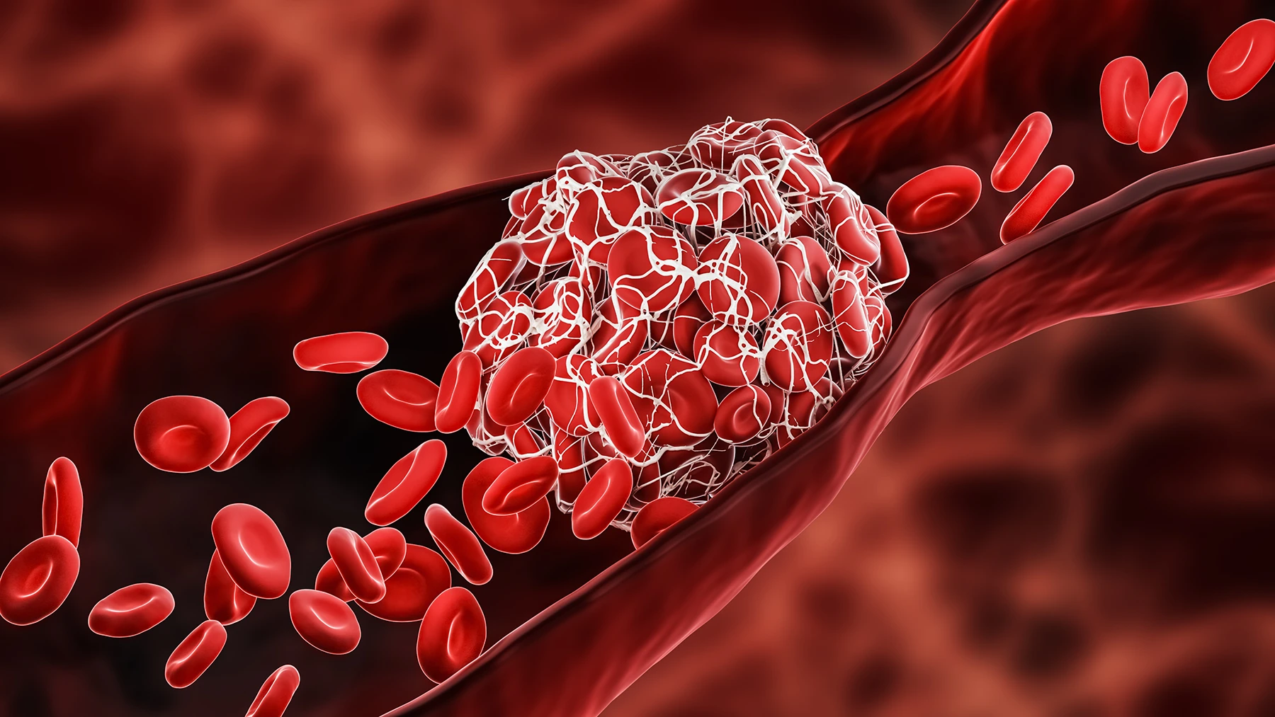 Blood Clot or thrombus blocking the red blood cells stream within an artery or a vein 3D rendering illustration.