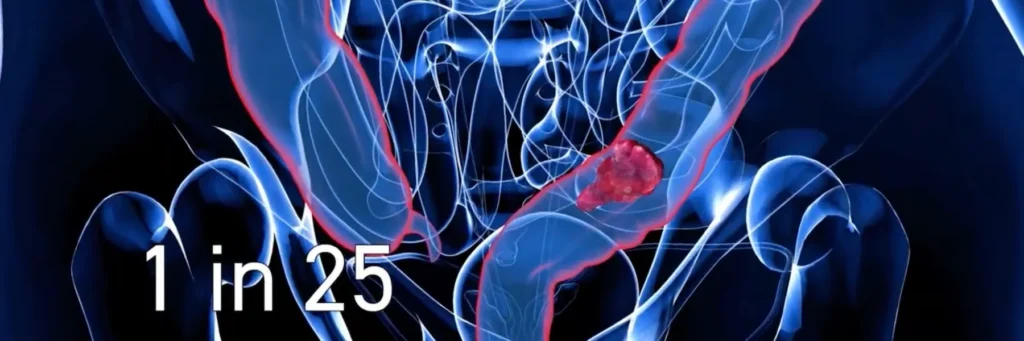 3D medical illustration of the human colon, highlighted in red, with a cancerous tumor inside. The text "1 in 25" indicates the risk of colorectal cancer.