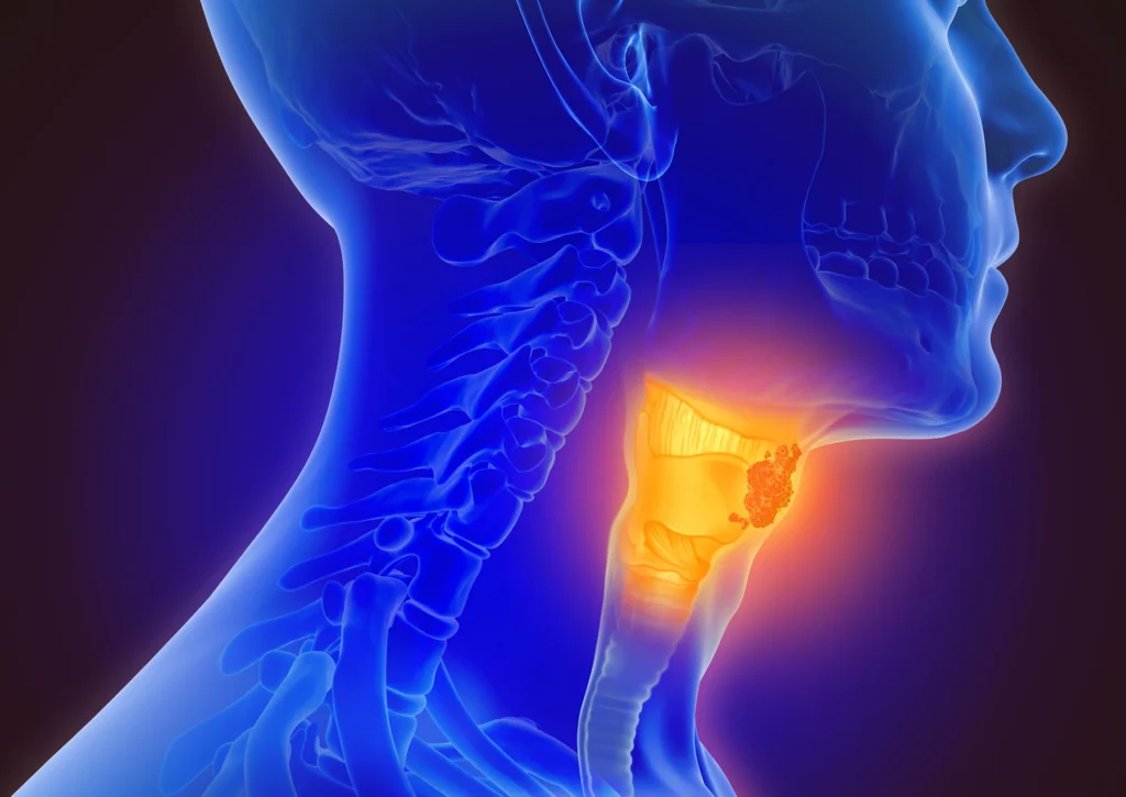 3d illustration of throat cancer - stock photo