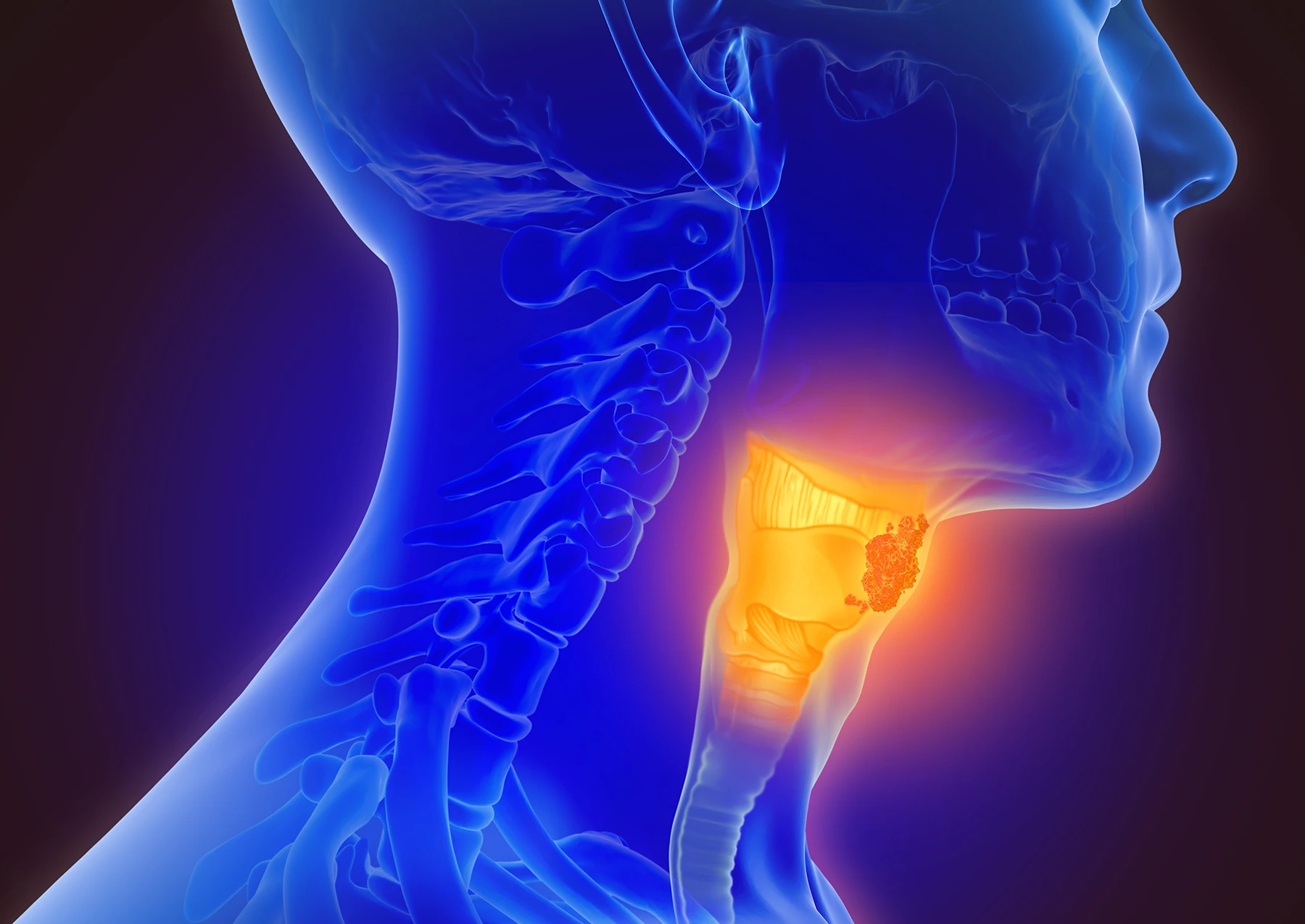 3d illustration of throat cancer - stock photo