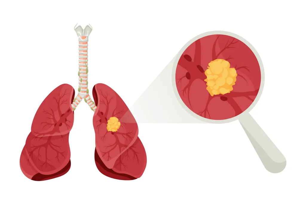 Diagram lung nodule. Concept disease human internal organs. Vector illustration, cartoon style. - stock illustration